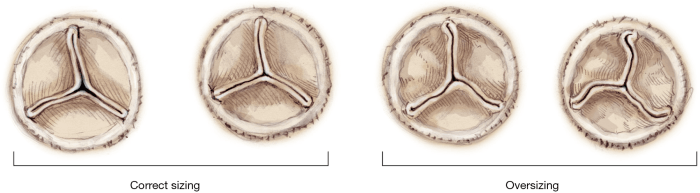 Correctly label the following parts of the heart valves